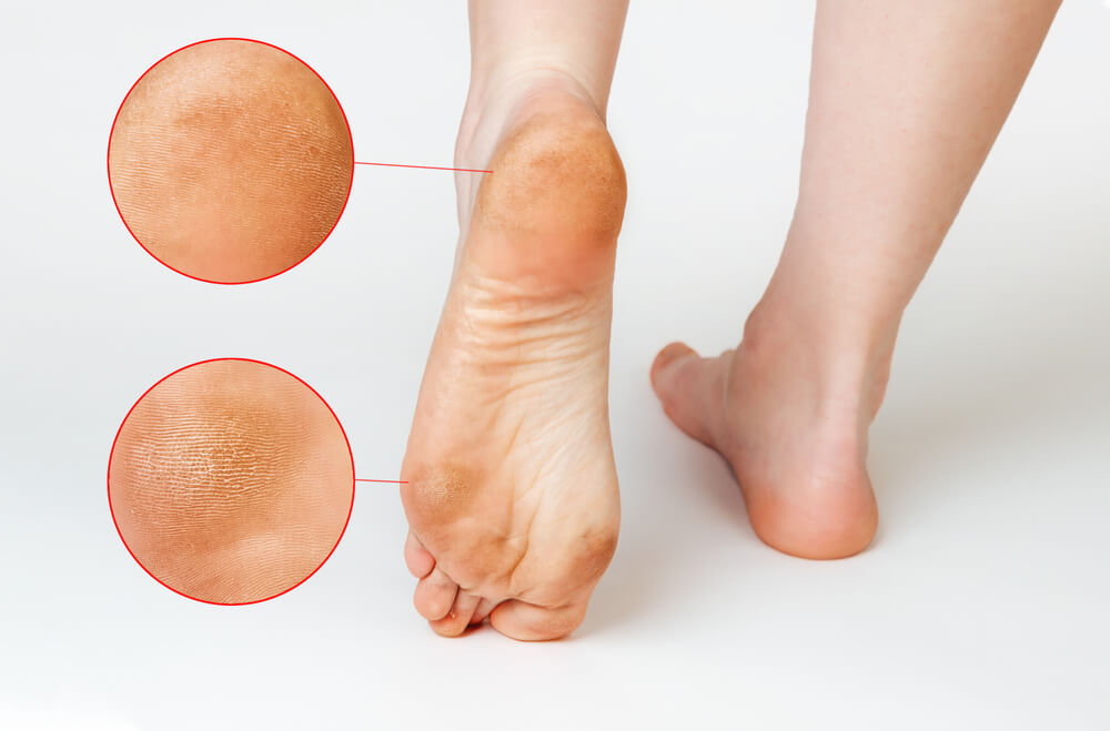 Painful Callus On Ball Of Foot Pictures