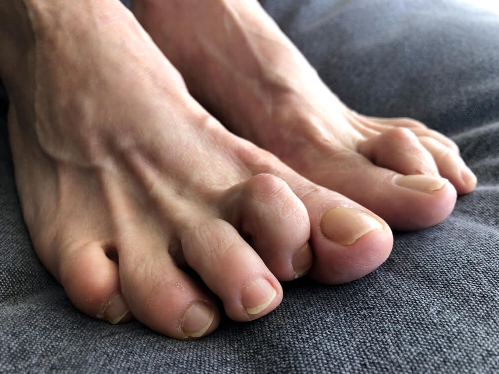 Hammer Toe Relief At Appalachian Foot Ankle Associates