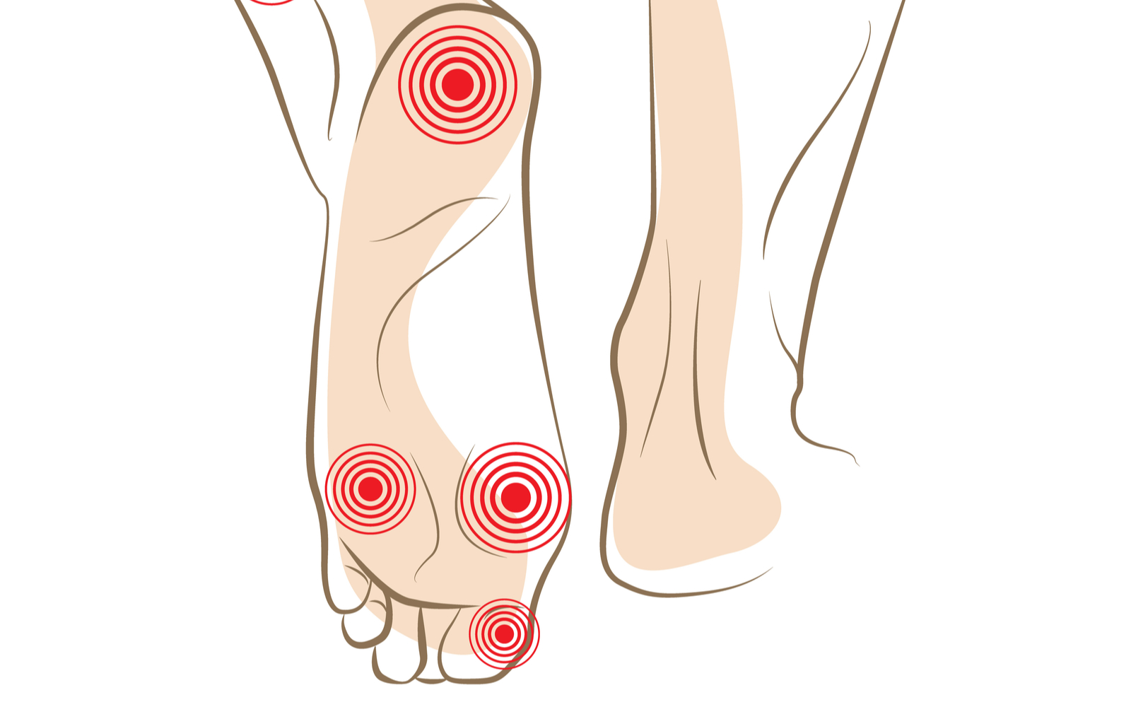 Illustration of foot with pain points